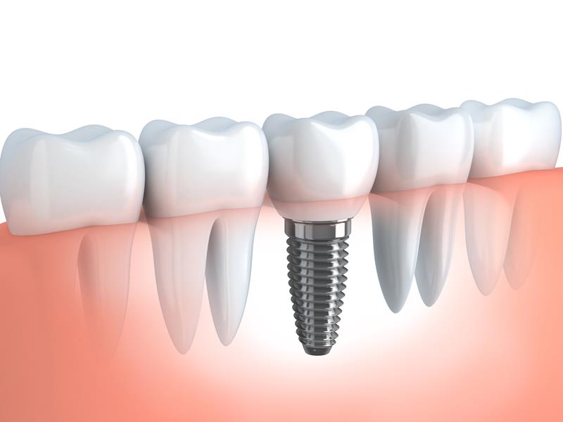 Dental Implants  St. Charles, MO 